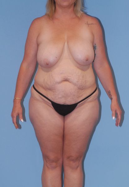 Mommy Makeover Before & After