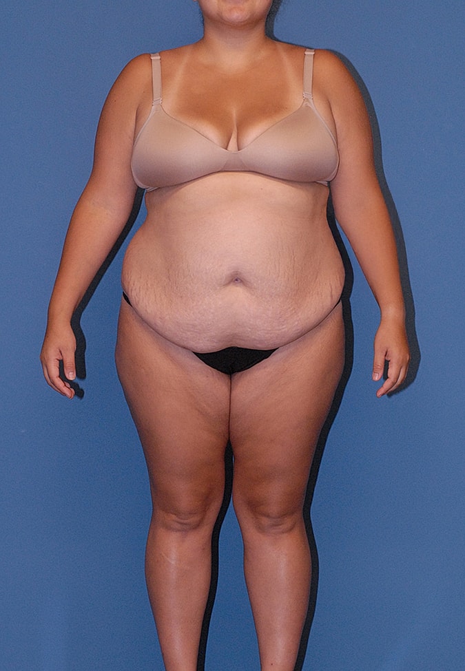 Mommy Makeover Before & After