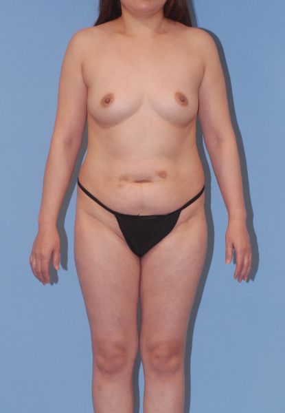 Mommy Makeover Before & After