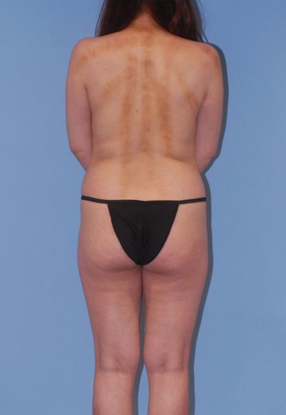 Mommy Makeover Before & After