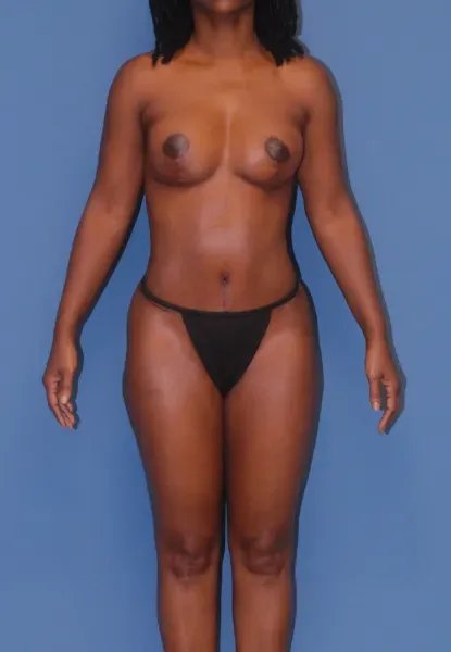 Mommy Makeover Before & After