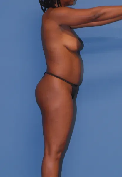 Mommy Makeover Before & After