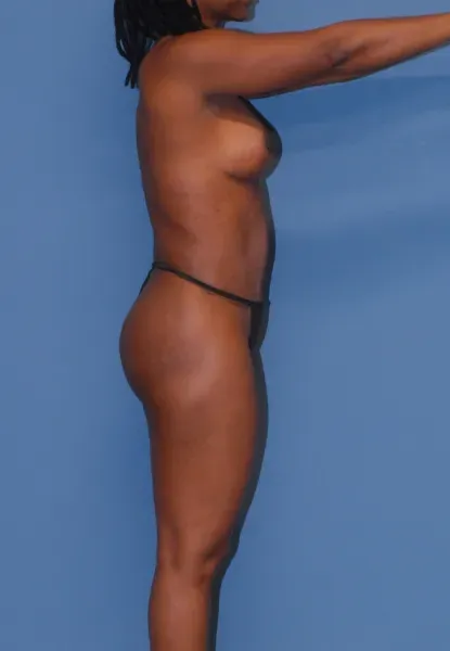 Mommy Makeover Before & After