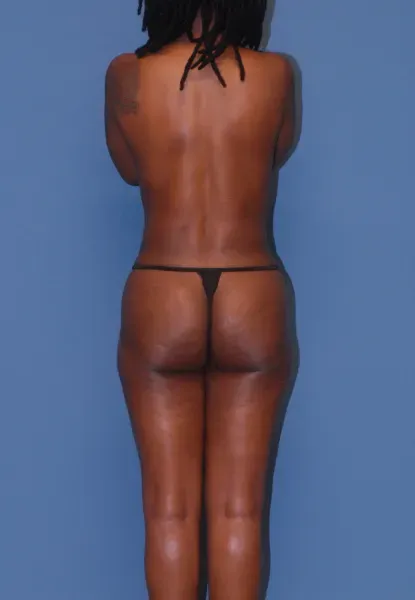 Mommy Makeover Before & After