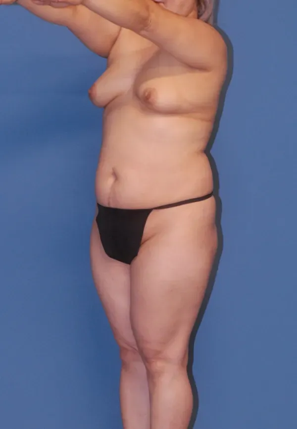 Mommy Makeover Before & After