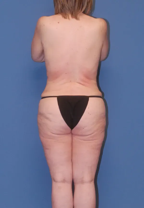 Mommy Makeover Before & After