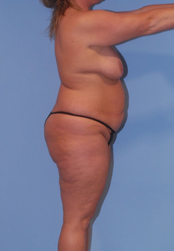 Mommy Makeover Before & After