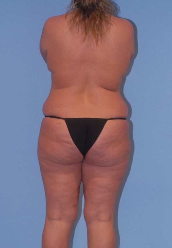 Mommy Makeover Before & After