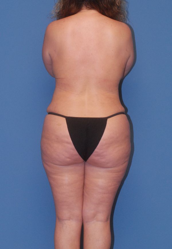 Mommy Makeover Before & After