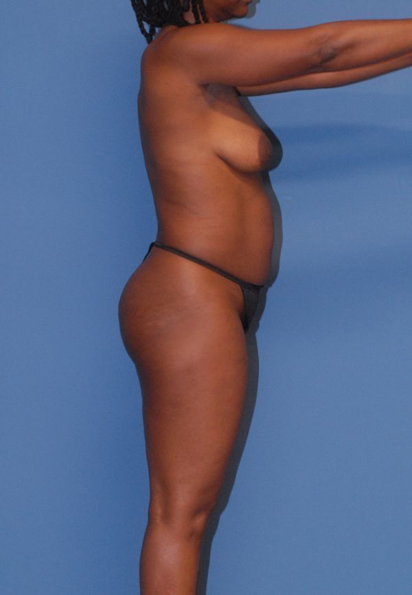 Mommy Makeover Before & After