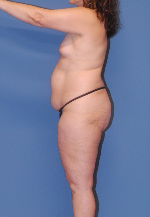 Mommy Makeover Before & After