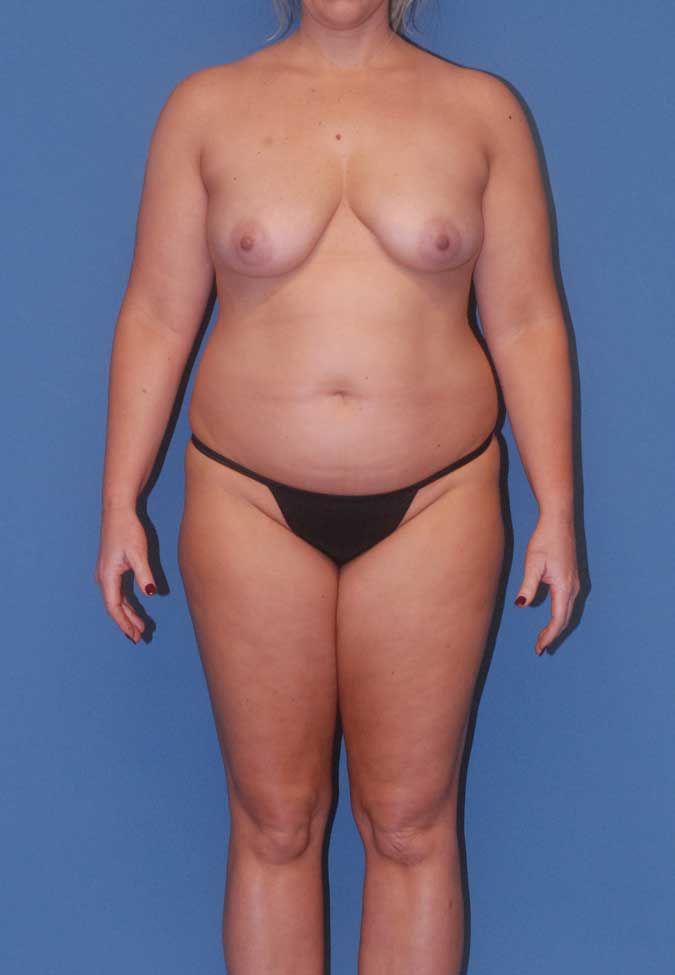 Mommy Makeover Before & After