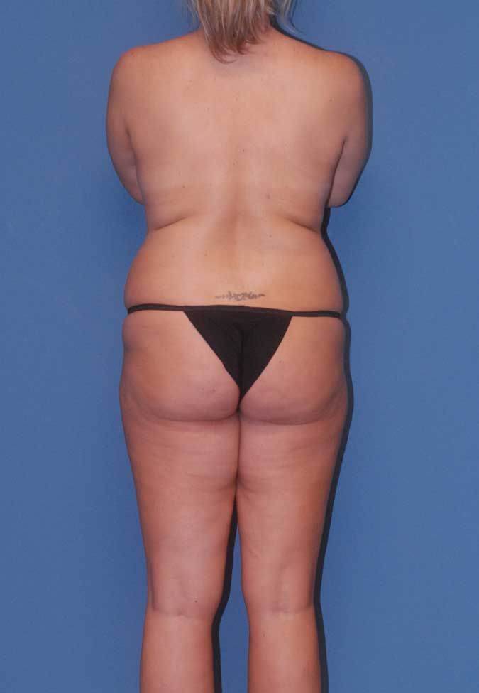 Mommy Makeover Before & After