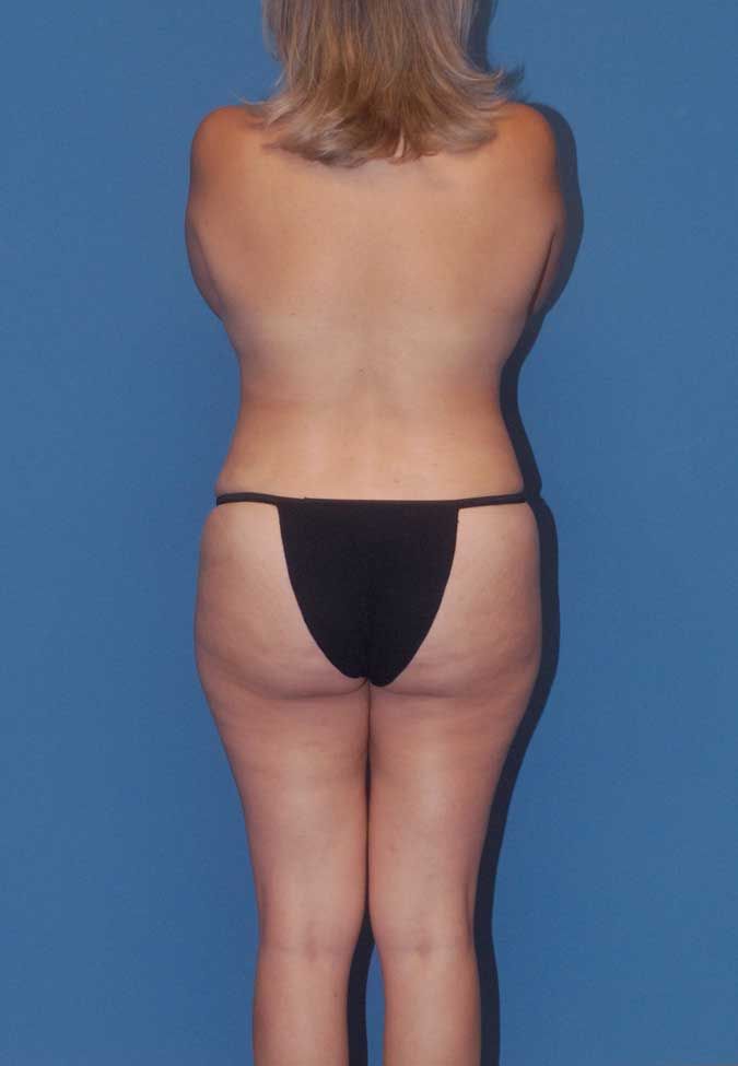 Mommy Makeover Before & After