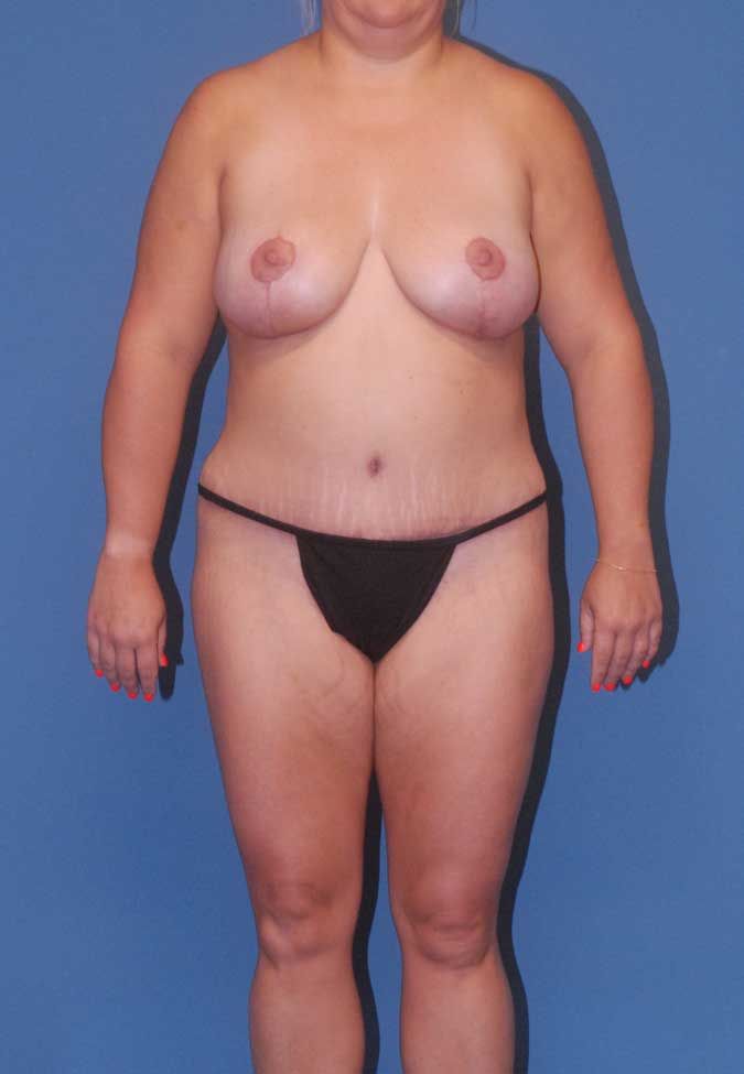 Mommy Makeover Before & After