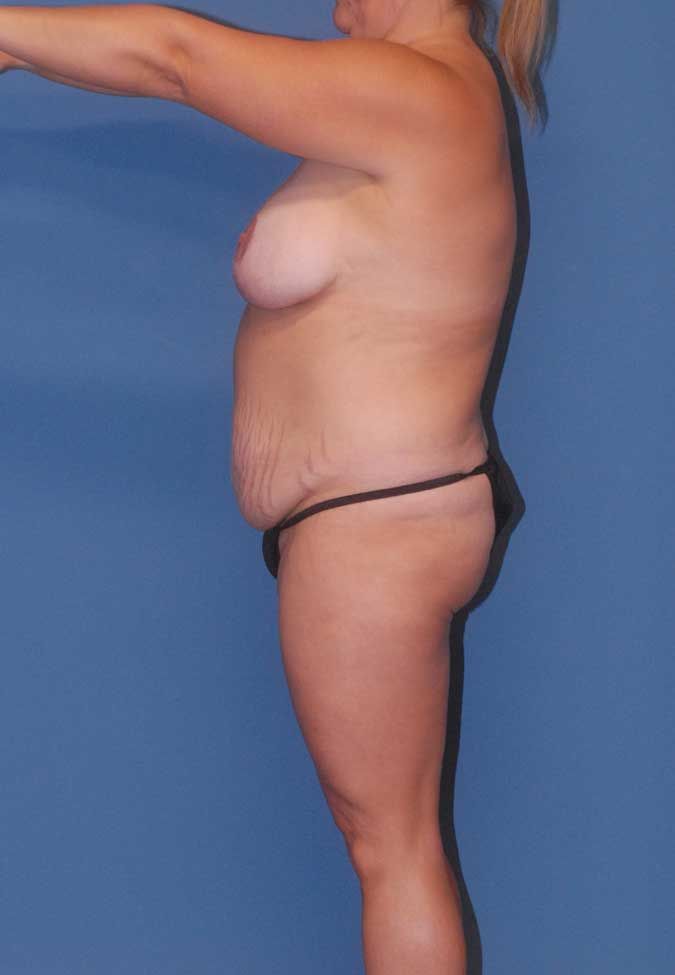 Mommy Makeover Before & After