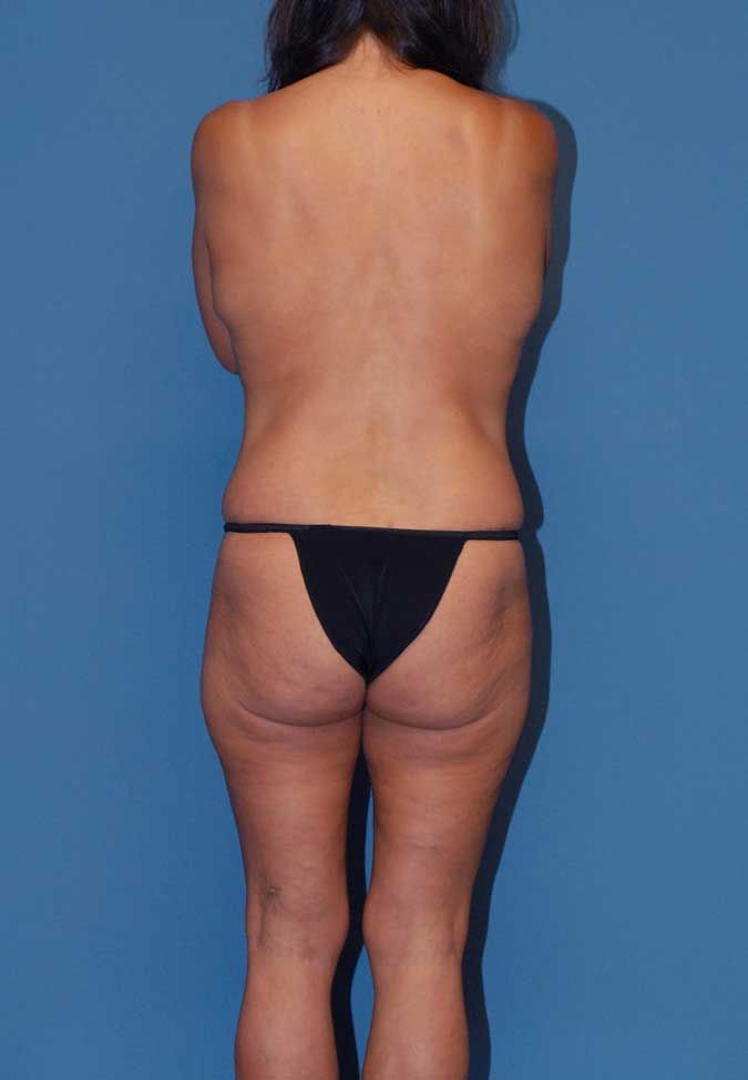 Mommy Makeover Before & After