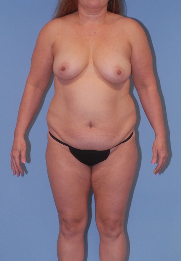 Mommy Makeover Before & After