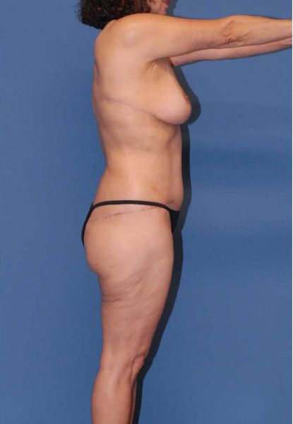 Mommy Makeover Before & After