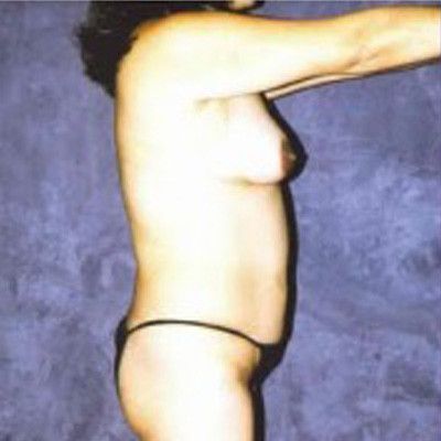 Liposuction Before & After