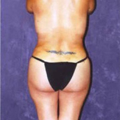 Liposuction Before & After