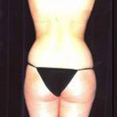 Liposuction Before & After