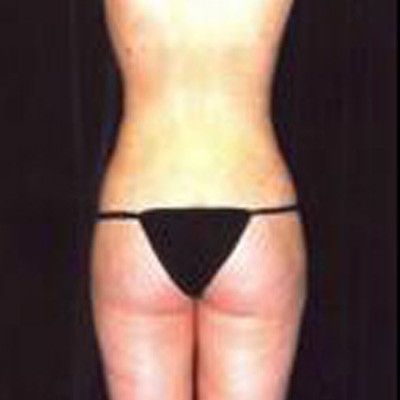 Liposuction Before & After