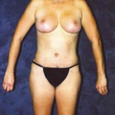 Liposuction Before & After