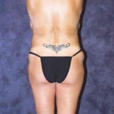 Liposuction Before & After
