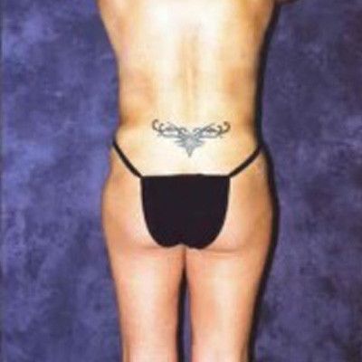 Liposuction Before & After