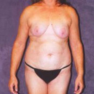 Liposuction Before & After