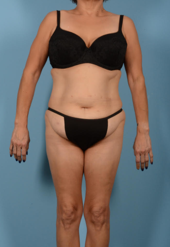 Liposuction Before & After
