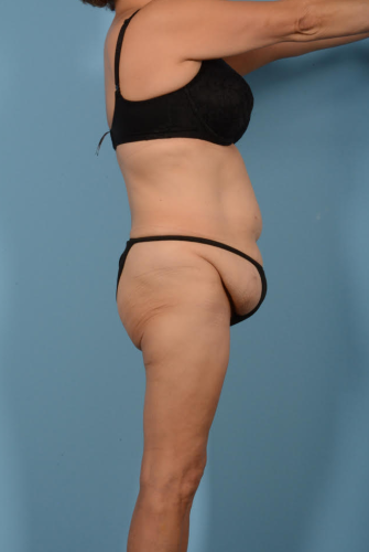Liposuction Before & After