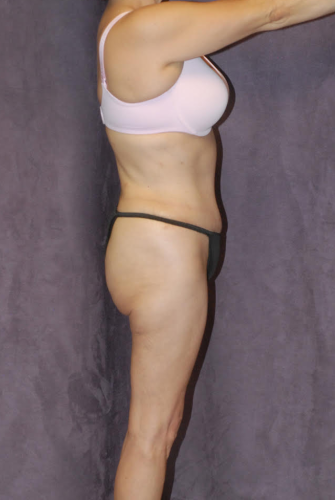 Liposuction Before & After