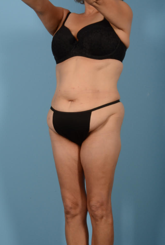 Liposuction Before & After