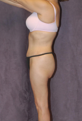 Liposuction Before & After