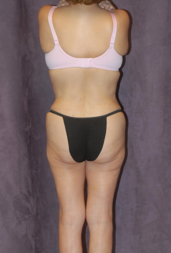 Liposuction Before & After