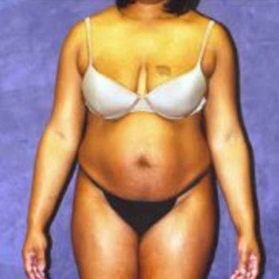 Liposuction Before & After