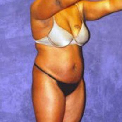 Liposuction Before & After