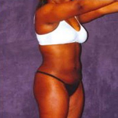 Liposuction Before & After