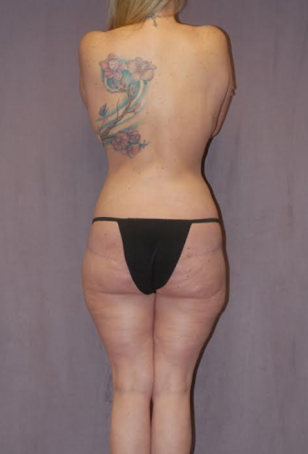 Liposuction Before & After