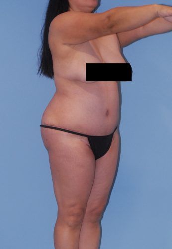 Liposuction Before & After