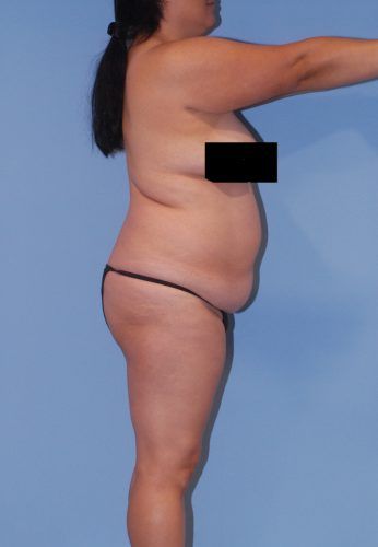 Liposuction Before & After