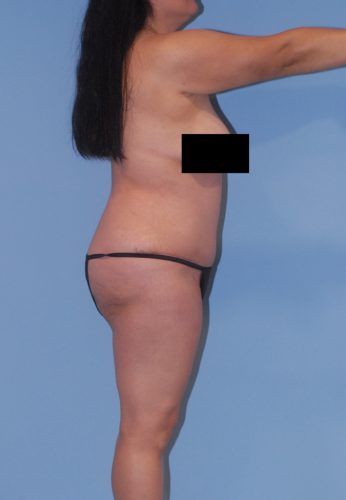 Liposuction Before & After