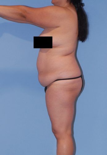 Liposuction Before & After