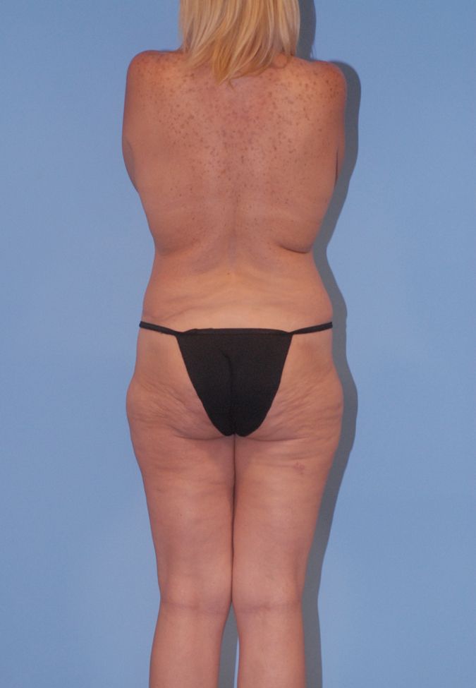 Liposuction Before & After