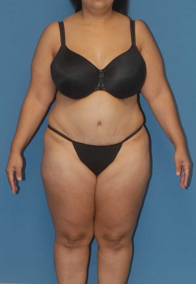 Liposuction Before & After