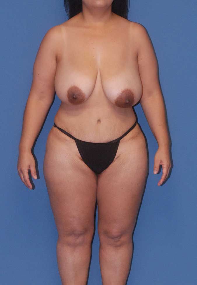 Liposuction Before & After