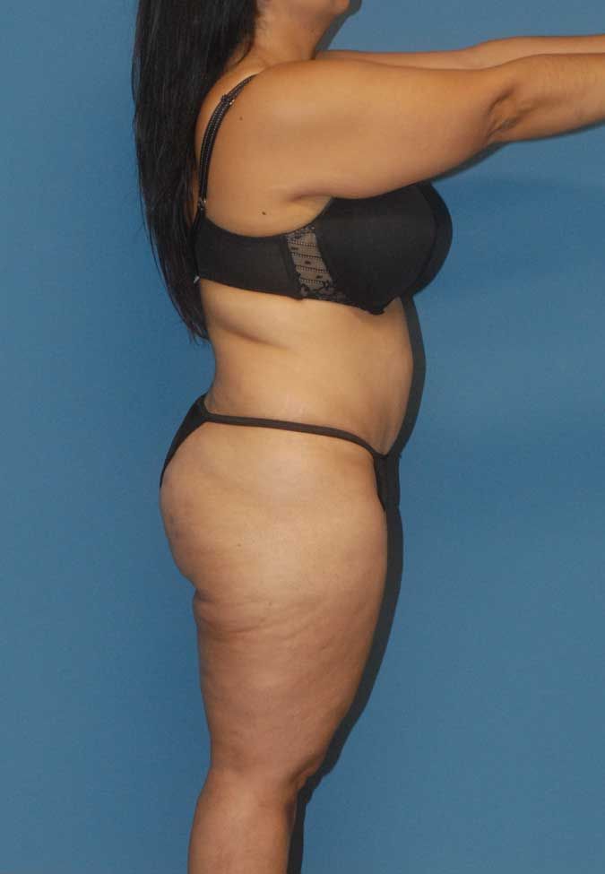 Liposuction Before & After