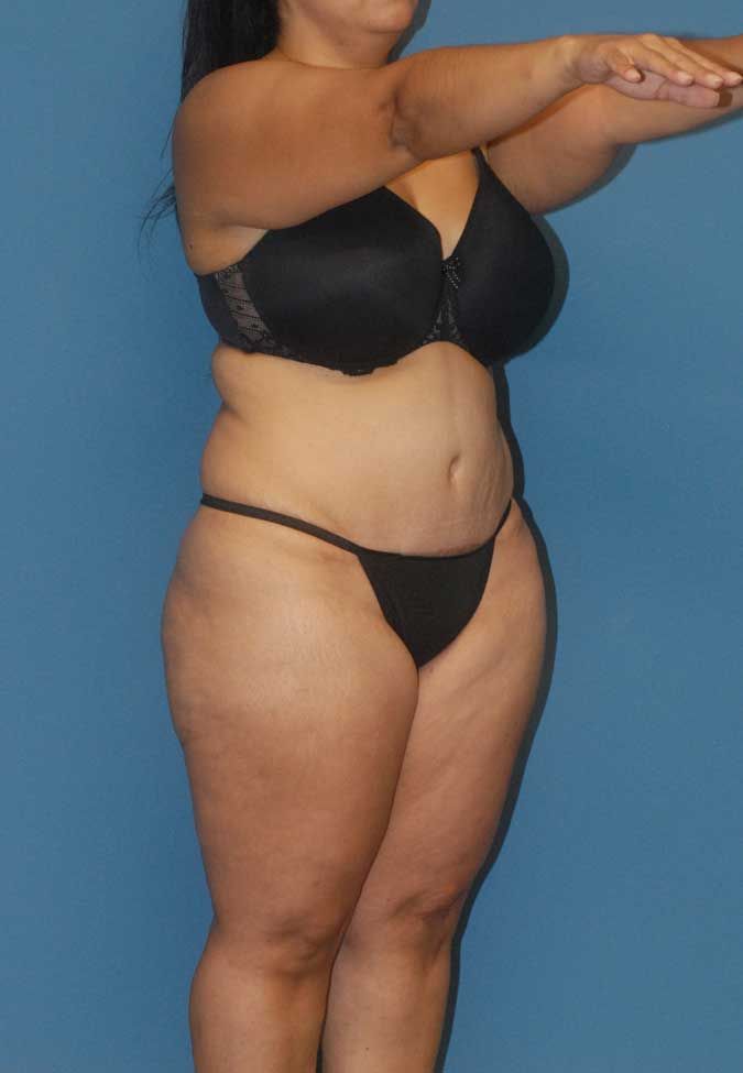 Liposuction Before & After